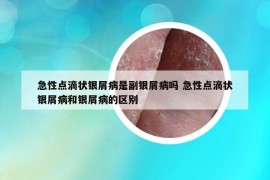 急性点滴状银屑病是副银屑病吗 急性点滴状银屑病和银屑病的区别