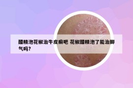 醋精泡花椒治牛皮癣吧 花椒醋精泡了能治脚气吗?