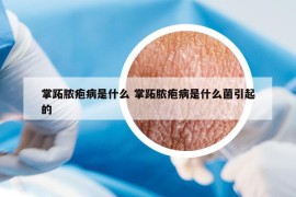 掌跖脓疱病是什么 掌跖脓疱病是什么菌引起的