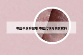 枣庄牛皮癣健康 枣庄比较好的皮肤科