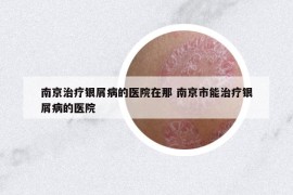 南京治疗银屑病的医院在那 南京市能治疗银屑病的医院