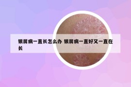 银屑病一直长怎么办 银屑病一直好又一直在长