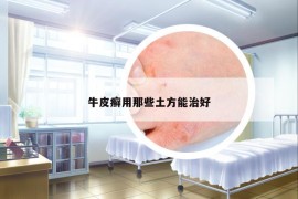 牛皮癣用那些土方能治好