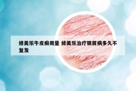 修美乐牛皮癣用量 修美乐治疗银屑病多久不复发