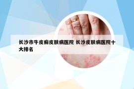 长沙市牛皮癣皮肤病医院 长沙皮肤病医院十大排名