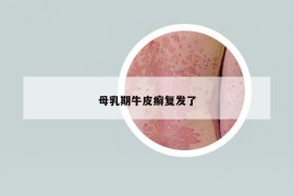 母乳期牛皮癣复发了
