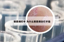 银屑病烂手 为什么银屑病会烂手指