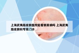 上海武夷路皮肤医院能看银屑病吗 上海武夷路皮肤科专家门诊