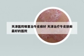 天津医院哪里治牛皮癣好 天津治疗牛皮肤癣最好的医院