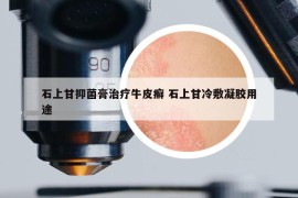 石上甘抑菌膏治疗牛皮癣 石上甘冷敷凝胶用途