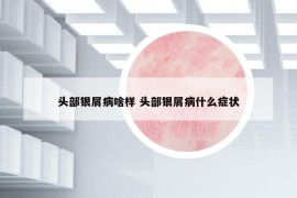 头部银屑病啥样 头部银屑病什么症状