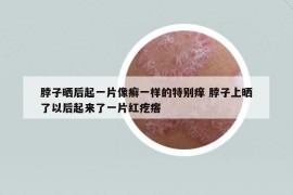 脖子晒后起一片像癣一样的特别痒 脖子上晒了以后起来了一片红疙瘩