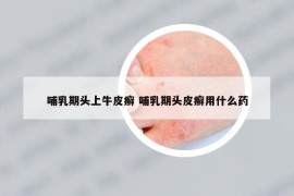 哺乳期头上牛皮癣 哺乳期头皮癣用什么药