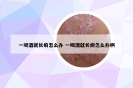 一喝酒就长癣怎么办 一喝酒就长癣怎么办啊