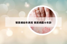 银屑病幼年表现 银屑病最小年龄