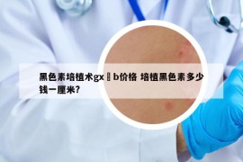 黑色素培植术gx–b价格 培植黑色素多少钱一厘米?