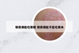 银屑病能吃黑糖 银屑病能不能吃黑米