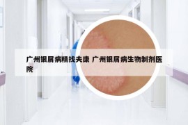 广州银屑病精找夫康 广州银屑病生物制剂医院