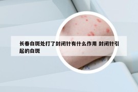 长春白斑处打了封闭针有什么作用 封闭针引起的白斑