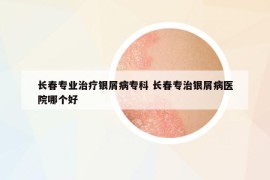 长春专业治疗银屑病专科 长春专治银屑病医院哪个好