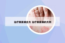 治疗银屑病古方 治疗银屑病的方剂