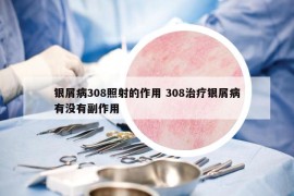银屑病308照射的作用 308治疗银屑病有没有副作用