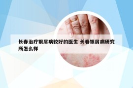 长春治疗银屑病较好的医生 长春银屑病研究所怎么样