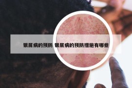 银屑病的预防 银屑病的预防措施有哪些