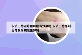 卡泊三醇治疗银屑病有效果吗 卡泊三醇搽剂治疗银屑病效果好吗