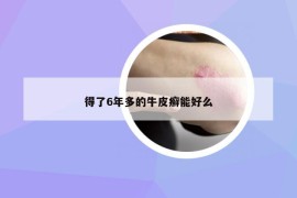 得了6年多的牛皮癣能好么