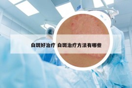 白斑好治疗 白斑治疗方法有哪些