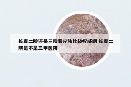 长春二院还是三院看皮肤比较权威啊 长春二院是不是三甲医院