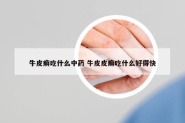 牛皮癣吃什么中药 牛皮皮癣吃什么好得快