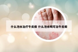 什么泡水治疗牛皮癣 什么泡水喝可治牛皮癣