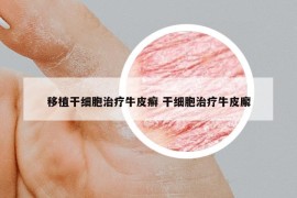 移植干细胞治疗牛皮癣 干细胞治疗牛皮廨