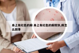 身上有红色的癣 身上有红色的癣斑快,痒怎么回事