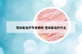雪水能治疗牛皮癣吗 雪水能治疗什么