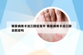 银屑病用卡泊三醇后变平 银屑病用卡泊三醇会脱皮吗