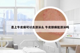 患上牛皮癣可以去游泳么 牛皮肤癣能游泳吗