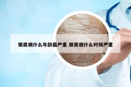 银屑病什么年龄最严重 银屑病什么时候严重
