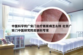 中医科学院广安门治疗银屑病怎么样 北京广安门中医研究院皮肤科专家