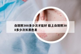 白斑照308多少次才能好 脸上白斑照308多少次长黑色素