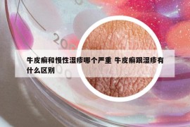 牛皮癣和慢性湿疹哪个严重 牛皮癣跟湿疹有什么区别