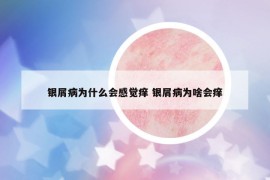 银屑病为什么会感觉痒 银屑病为啥会痒