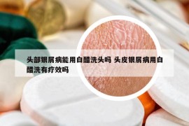 头部银屑病能用白醋洗头吗 头皮银屑病用白醋洗有疗效吗