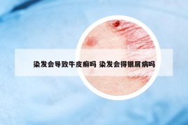 染发会导致牛皮癣吗 染发会得银屑病吗