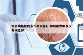 银屑病最快的多长时间能好 银屑病大概多少时间能好