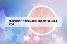 银屑病快好了周围红血丝 银屑病好转又冒小红点