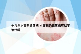 十几年小面积银屑病 小面积的银屑病可以不治疗吗