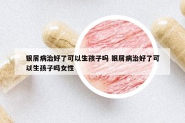 银屑病治好了可以生孩子吗 银屑病治好了可以生孩子吗女性